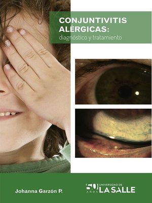 cover image of Conjuntivitis alérgicas